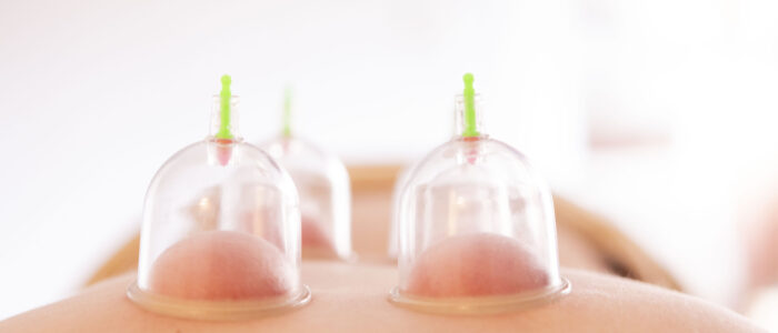 Ventosas que alivian el dolor, bajando la inflamación.